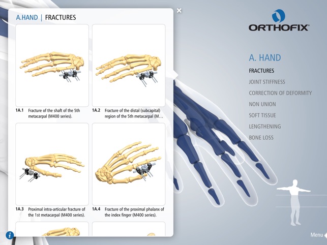 Orthofix Applications by Anatomical Site(圖4)-速報App