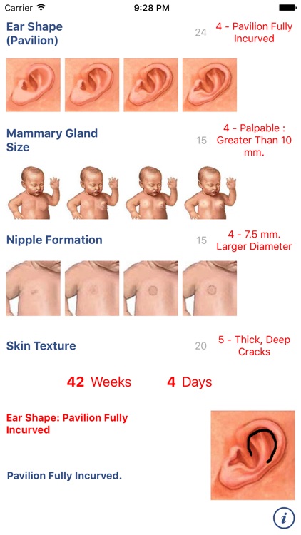 Neonatology: Test Capurro