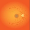 Vasculitis retiniana