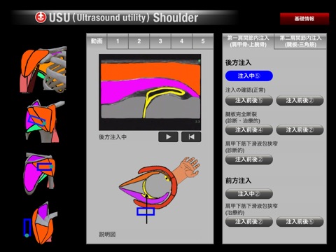 USU Shoulder screenshot 3