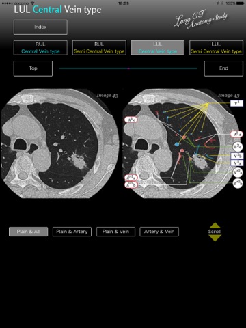 Lung CT Anatomy STUDY screenshot 4