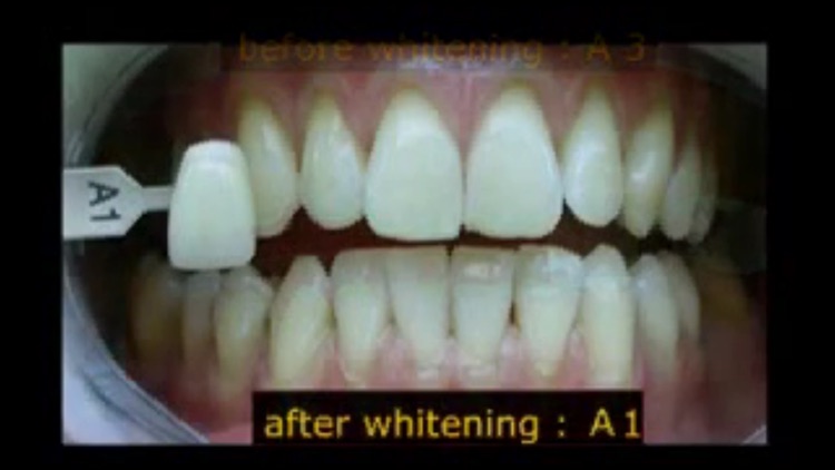 Teeth Whitening Techniques