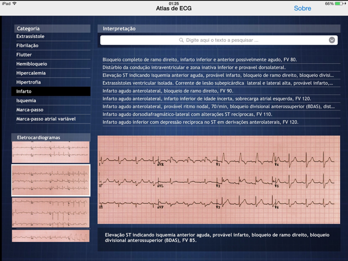 Atlas de ECG