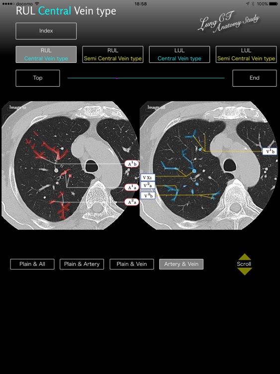 Lung CT Anatomy STUDY