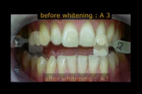 Teeth Whitening Techniques screenshot 4