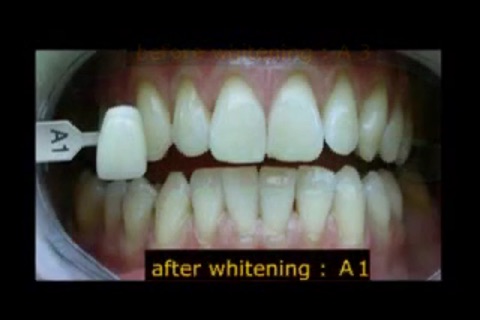 Teeth Whitening Techniques screenshot 3