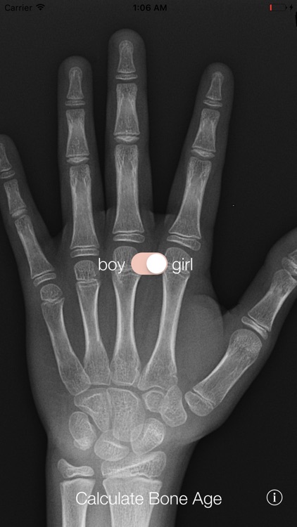 Bone Age