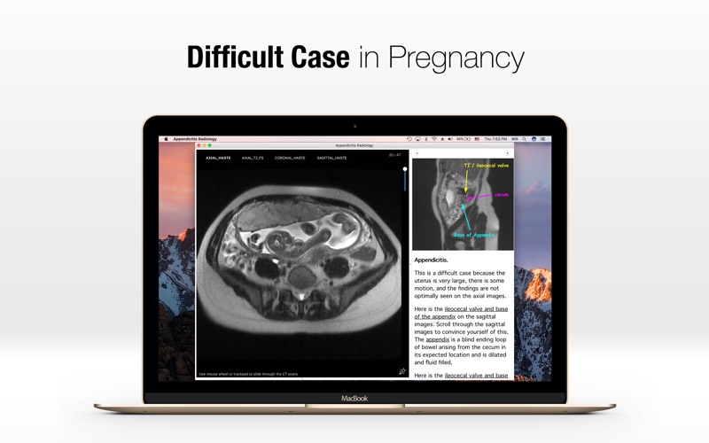 Appendicitis Radiology in Pregnancy thumbnail 1