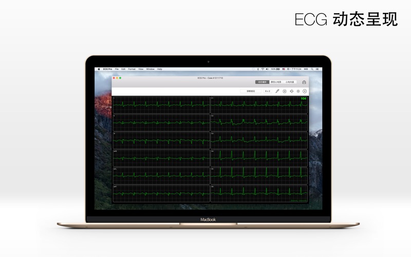 ECG Pro - 12导联静态和动态心电图案例