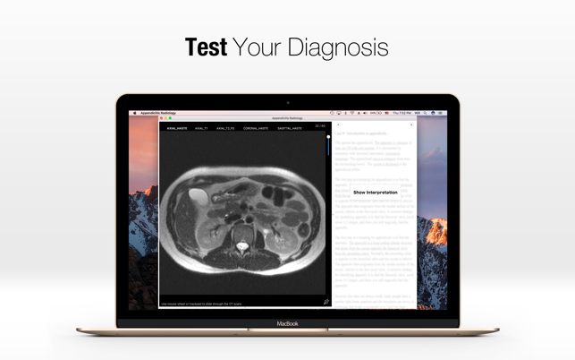 Appendicitis Radiology(圖3)-速報App