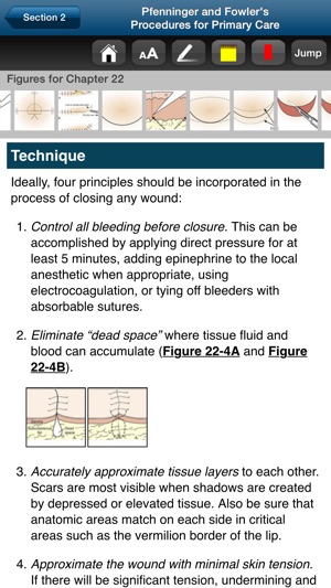 Pfenninger & Fowler Procedures(圖3)-速報App