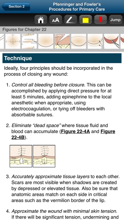 Pfenninger & Fowler Procedures