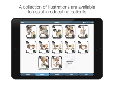 The Visual Consult: Hip Replacement screenshot 3