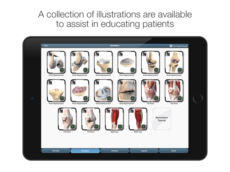 The Visual Consult: Knee Replacement