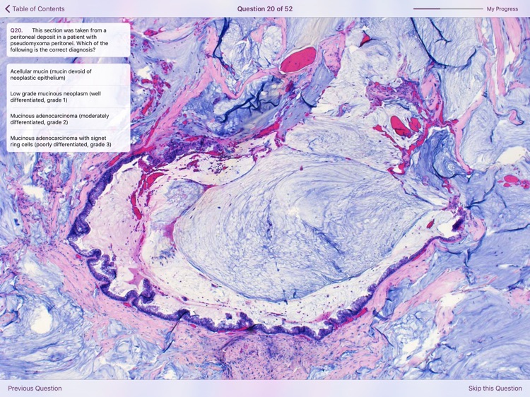 Appendiceal Pathology screenshot-3