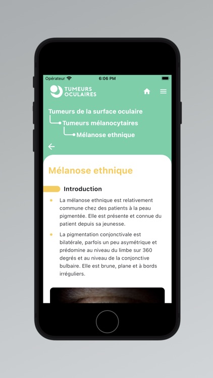Tumeurs Oculaires screenshot-3