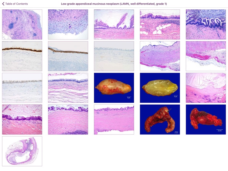 Appendiceal Pathology