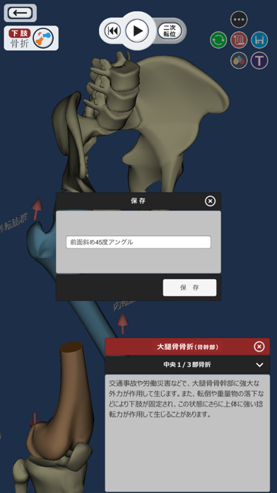 ３Dで分かる骨折と脱臼 screenshot1