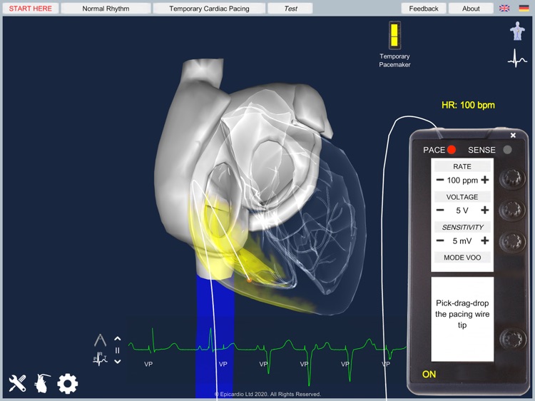 Temporary Cardiac Pacing