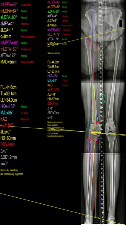 OsteotomyApp