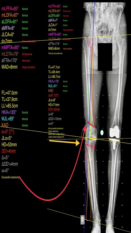 OsteotomyApp