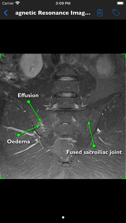 iAnkylosingSpondylitis Pro screenshot-7