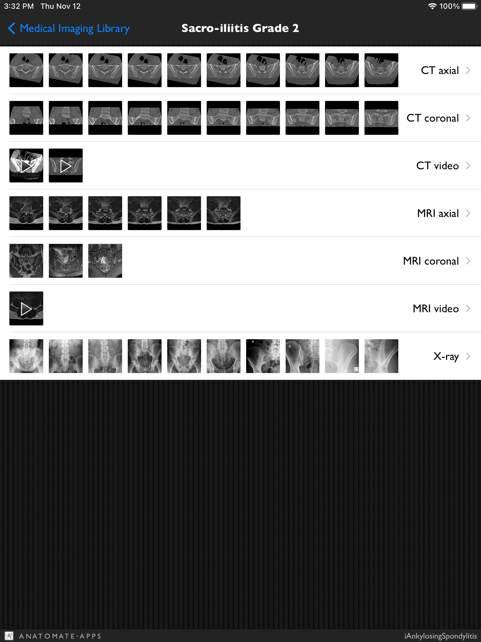 iAnkylosingSpondylitis Pro screenshot 3