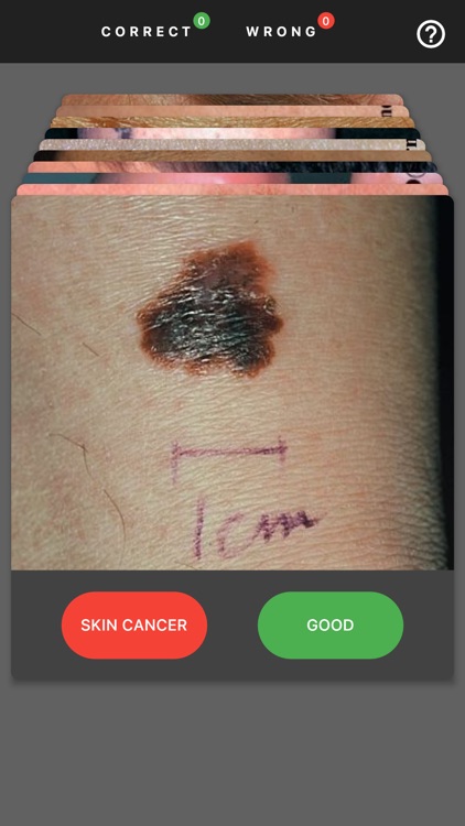 MelanomaExam