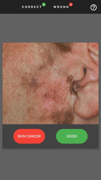 MelanomaExam screenshot-3