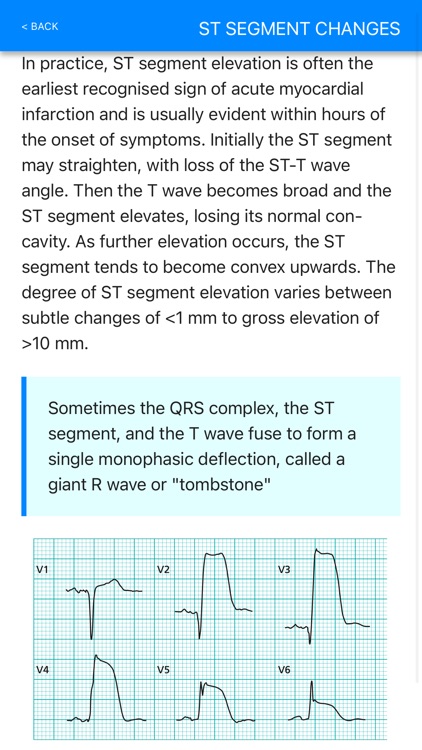 ECG Basics Pro - ECG Made Easy screenshot-4