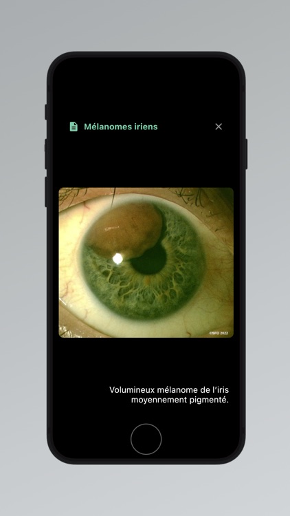 Tumeurs Oculaires screenshot-7