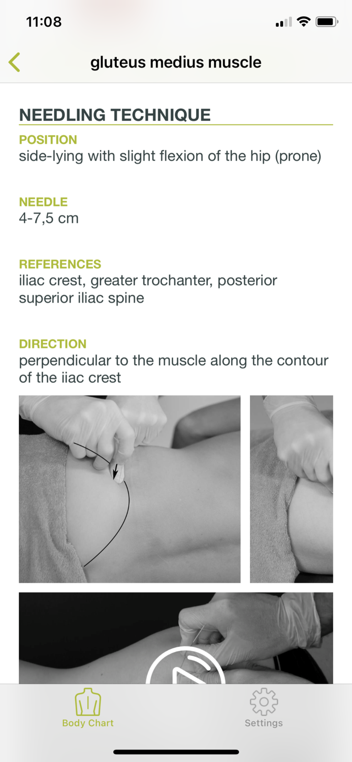 Dry Needling Guide